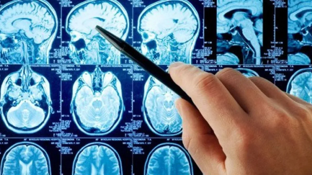 Exame de imagem cerebral sendo analisado