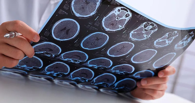 Análise de exame de imagem cerebral