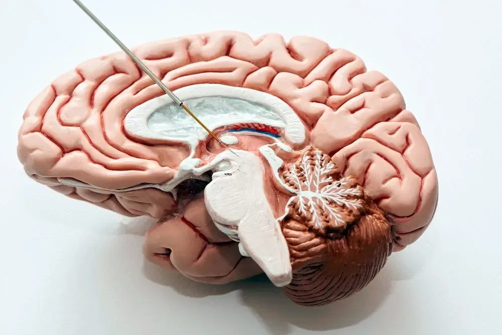 Modelo anatômico de cérebro ilustrando estimulação cerebral profunda