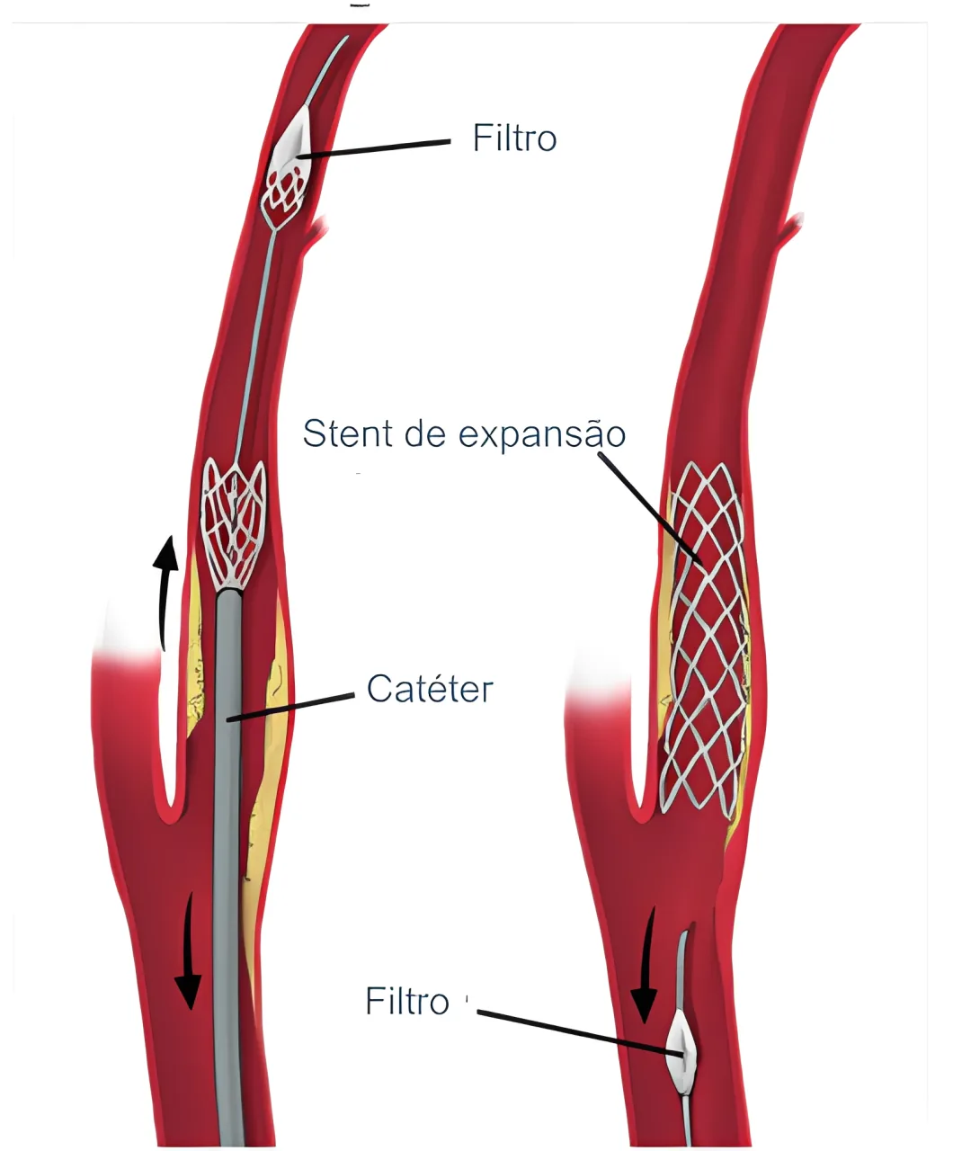Diagrama de filtro, cateter e stent de expansão em uma artéria carótida