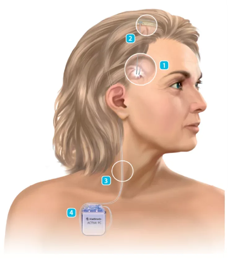 Ilustração de eletrodos e gerador utilizados na estimulação cerebral profunda
